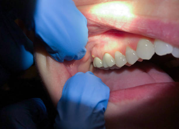 Best Emergency Tooth Extraction in Maury, NC
