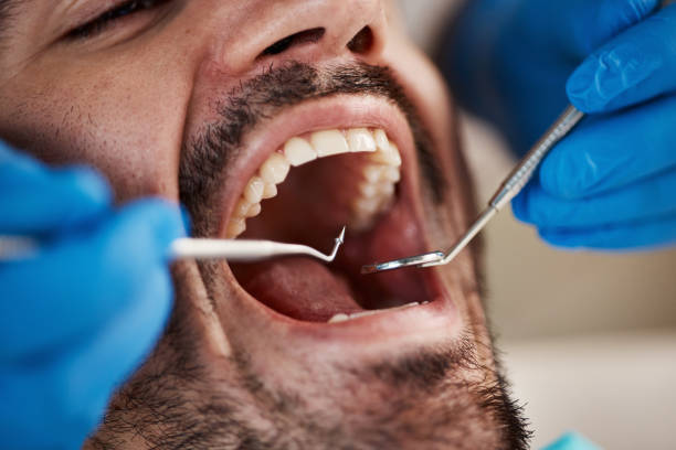 Best Emergency Wisdom Teeth Removal in Maury, NC